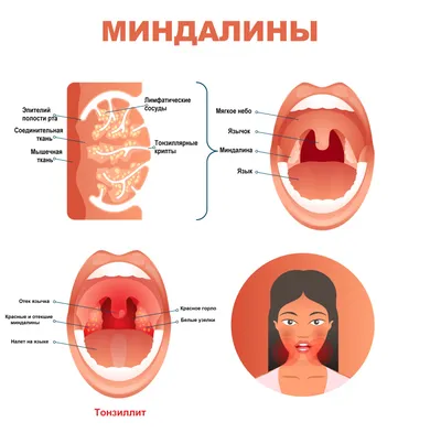 Сыпь На Корне Языка Прыщи Ближе к Горлу ЛюмиДент