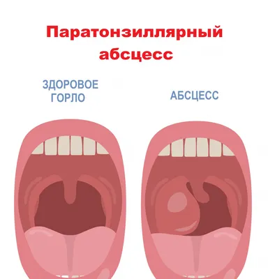 Симптомы и причины тонзиллита