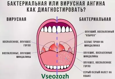 Рак гортани: симптомы, признаки, лечение, прогнозы