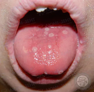 СТОМАТОЛОГИЯ | АСТАНА on Instagram: \"Белые точки на горле: что это такое?  Белые ⚪️ бляшки в горле в большинстве случаев представляют собой скопления  отмерших клеток слизистой оболочки и бактерий, которые могут принадлежать