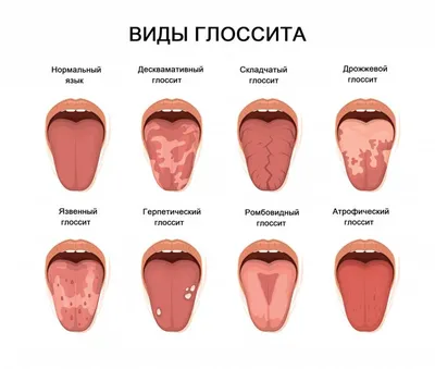 Ответы Mail.ru: Белые пятна в горле, появились после полоскания рта содой