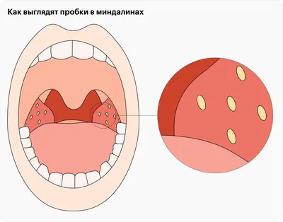 Как лечить молочницу полости рта | Новости Аркада-Мед