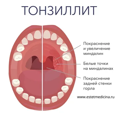 Стрептококковый фарингит — Википедия