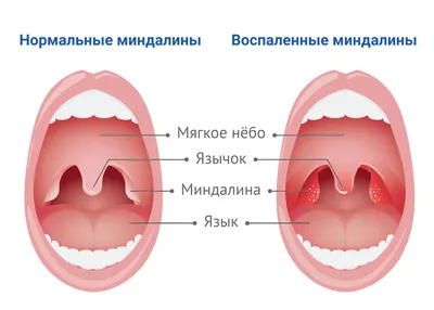 Хронический тонзиллит (ангина) при беременности | Интернет-журнал  Estetmedicina.ru