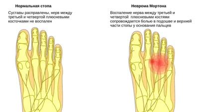 Удаление мозолей (стержневых,сухих) на ногах в Минске, лечение натоптышей  на ногах