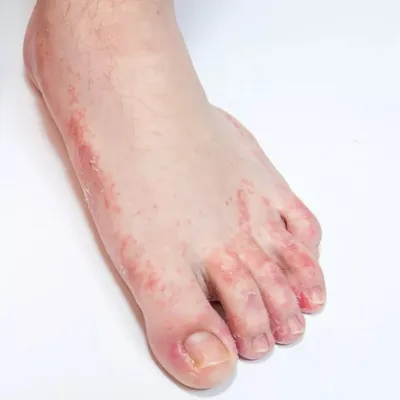 От чего болят ступни ног — причины, диагностика и лечение, как облегчить  боль в стопах | обзор магазина Vietnamki.ru