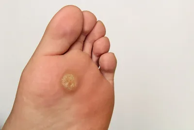 Шишка на ноге под кожей: распознавание уплотнений на руках, голени и бедре