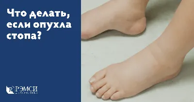 Бурсит – воспаление синовиальной сумки | Статьи клиники Ланцет