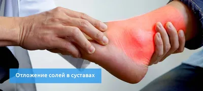 Лечение мозолей на мизинцах ног – цены на лечение сухих и болезненных  мозолей на мизинце в Москве | Клиника Полёт