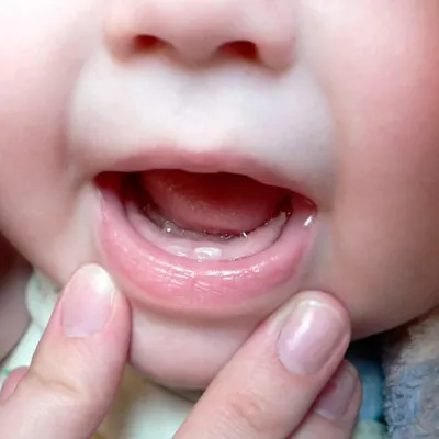 Прорезывание зубов у детей, что нужно знать