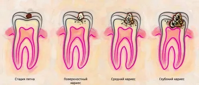 Кариес в стадии пятна: лечение, профилактика, причины