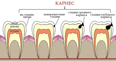 Начальный кариес: симптомы, причины, лечение, профилактика, фото белого  кариеса в стадии пятна, цены в Москве