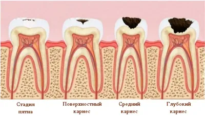 Начальный кариес: лечение, фото, диагностика | Интернет-журнал  Estetmedicina.ru