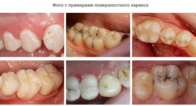 Боковой кариес - причины, симптомы, диагностика, лечение