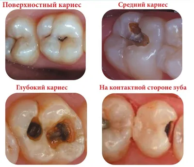 Лечение кариеса всех типов (поверхностный, средний, глубокий)