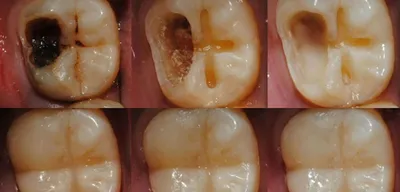 Глубокий кариес - Терапевтическая стоматология - «Аксиома Дентал»