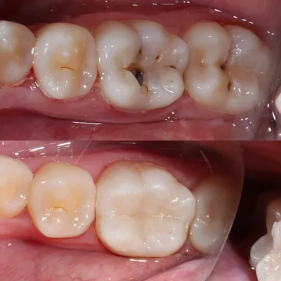 Глубокий кариес – лечение без боли за 1-2 приема Минск