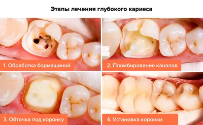 Фотографии лечения глубокого кариеса