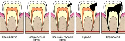 Глубокий кариес – особенности лечения и возможные осложнения