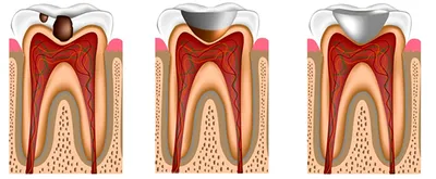 Глубокий кариес - Терапевтическая стоматология - «Аксиома Дентал»