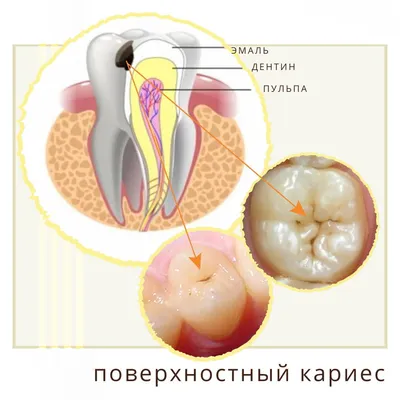 Начальный кариес: лечение и профилактика