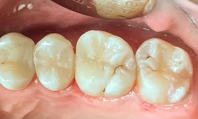 Поверхностный кариес — лечение и диагностика ❘ Стоматология Ортодонт  Комплекс