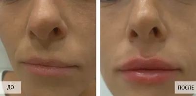 Контурная пластика, увеличение губ филлерами гиалуроновой кислоты в клинике  Медицина для Вас. Фото увеличения губ до и после. Врачи косметологи.