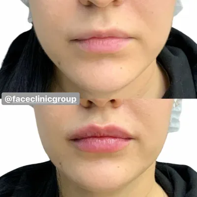 Алкоголь до и после увеличения губ - Cosmetic-clinic