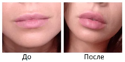 Увеличение губ с помощью инъекций