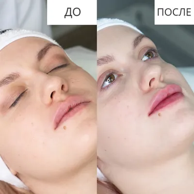 Увеличение губ в Севастополе без операции косметология «Водолей»