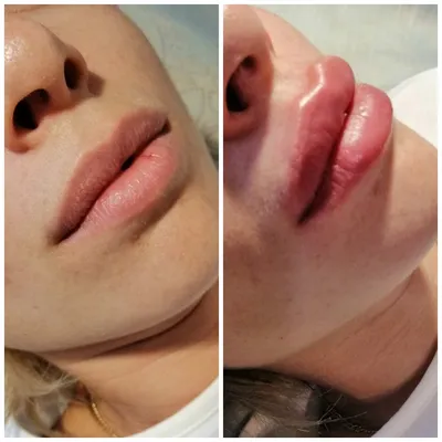 Увеличение губ - Клиника косметологии: лазерная эпиляция | увеличение губ |  перманентный макияж | похудение - V-klinik