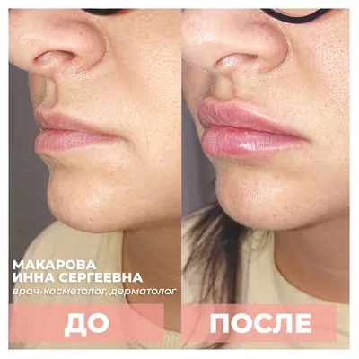 Увеличение губ гиалуроновой кислотой в Москве: цена процедуры | Увеличить  губы | Контурная пластика губ в клинике