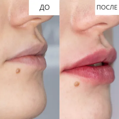 Как выглядят ЗАЖИВШИЕ губы после 1 мл филлера , спустя 3 недели . Dr.  Matveeva #увеличениегуб #красивыегубы #косметолог… | Instagram