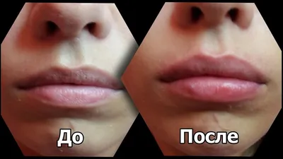 Увеличение губ - Клиника косметологии: лазерная эпиляция | увеличение губ |  перманентный макияж | похудение - V-klinik