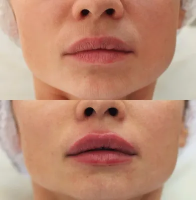 Фото до и после увеличения губ филлерами
