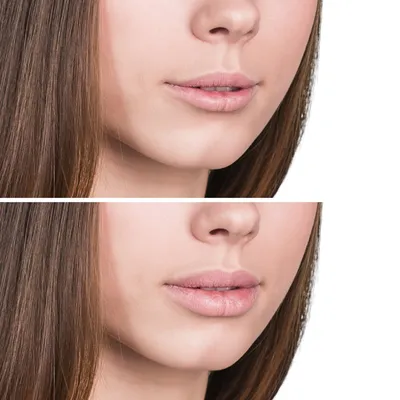 Контурная пластика губ фото до и после: особенности процедуры | Vidnova