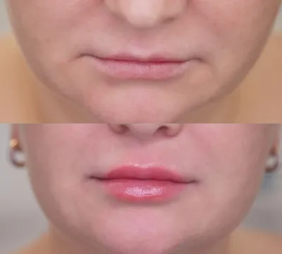 Как выглядят губы после увеличения? Реальные фото до и после! | Красота и  уход | Дзен