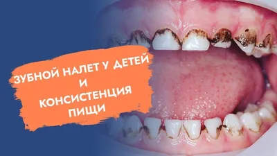 Черный налет на зубах – налет Пристли у детей