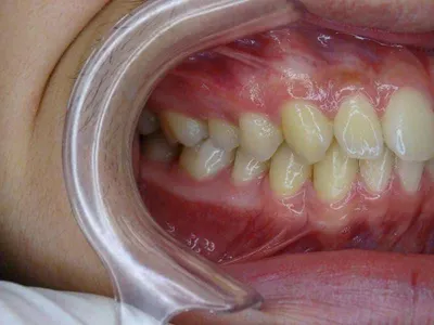 Свищ на десне: причины, как выявить и что делать? - DentBerg