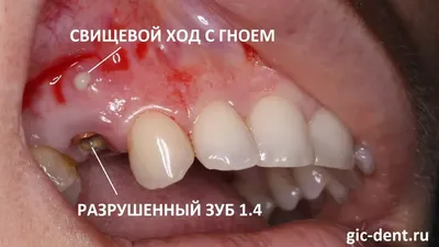 Белые пятна (точки) на зубах у ребенка - причины, симптомы, диагностика,  лечение, профилактика