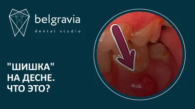 Киста на зубе - как появляется и как лечить? - Slavia.ua