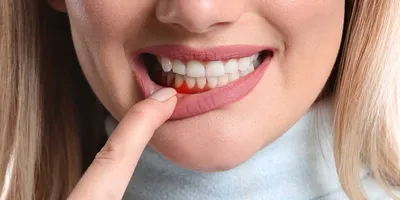 Лечение флюса на десне — Gorstom
