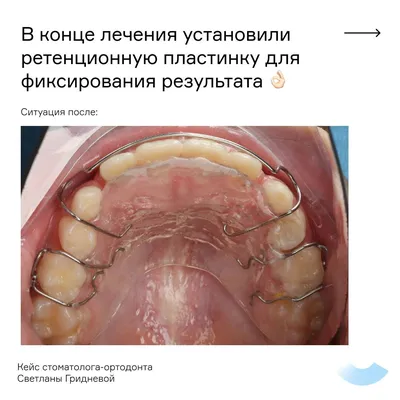 Лечение флюса (периостита): методы лечения, профилактика, цена в Москве