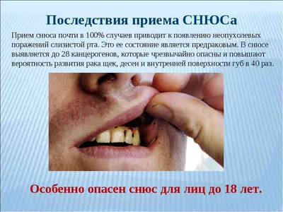 Насвай - враг желудка
