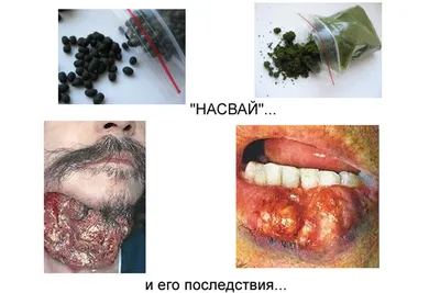 Что такое насвай? - Ренессанс Киев