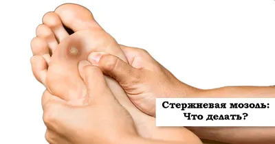 Removal of calluses on the foot / Interdigital callus - YouTube