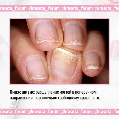 Болезни по ногтям (58 фото)