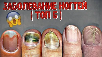 топ 5 заболеваний на ногтях - YouTube