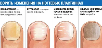 Определение болезни по ногтям - 54 фото