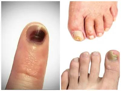 Заболевания ногтей